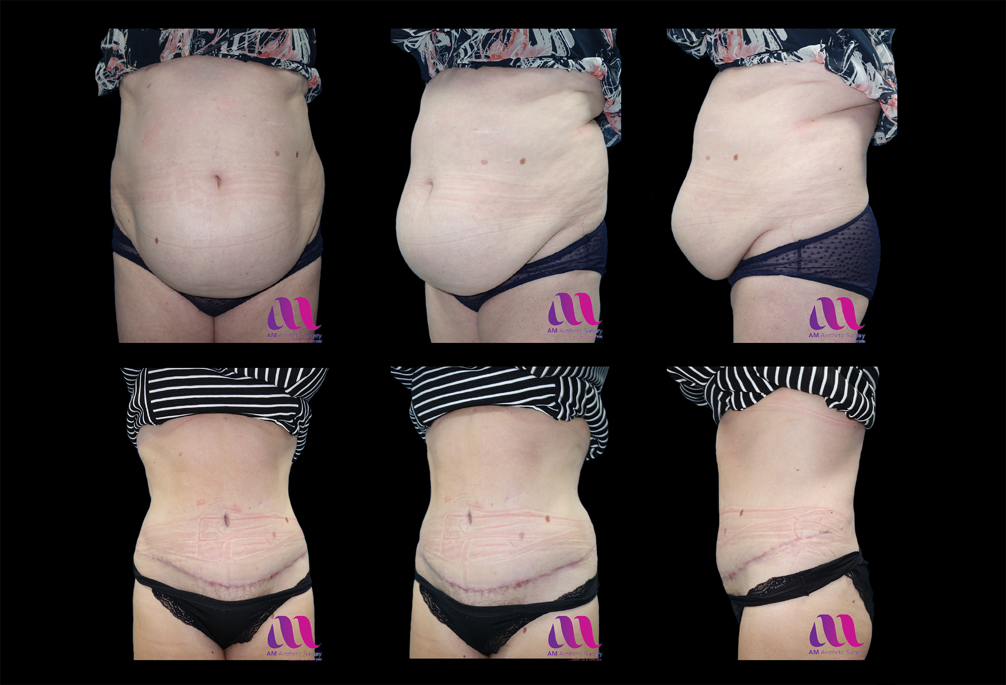 8 days post op Tummy Tuck, the swelling and tightness increasing instead of  decreasing. Is this normal? (photo)