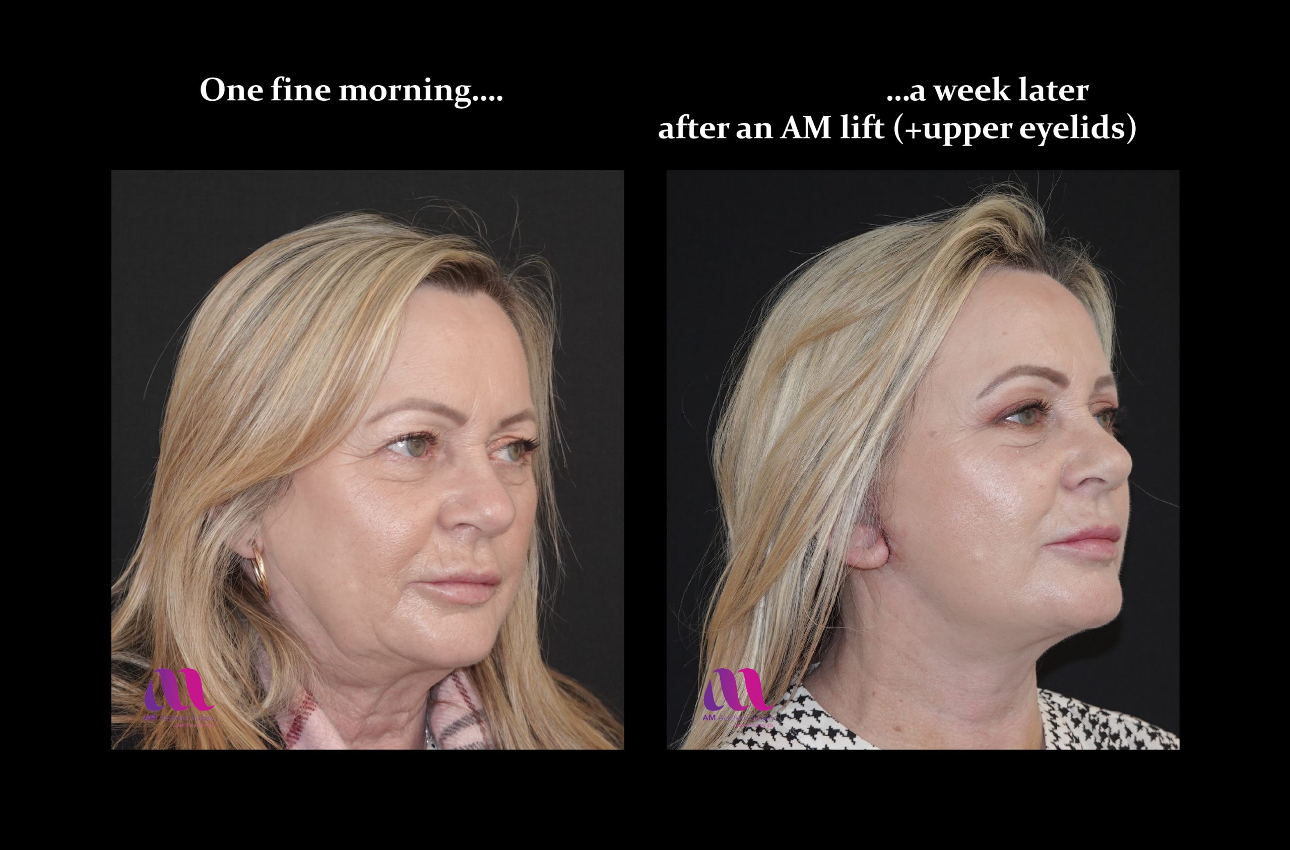 Gulf Coast Plastic Surgery - This patient is 6 weeks post-op from