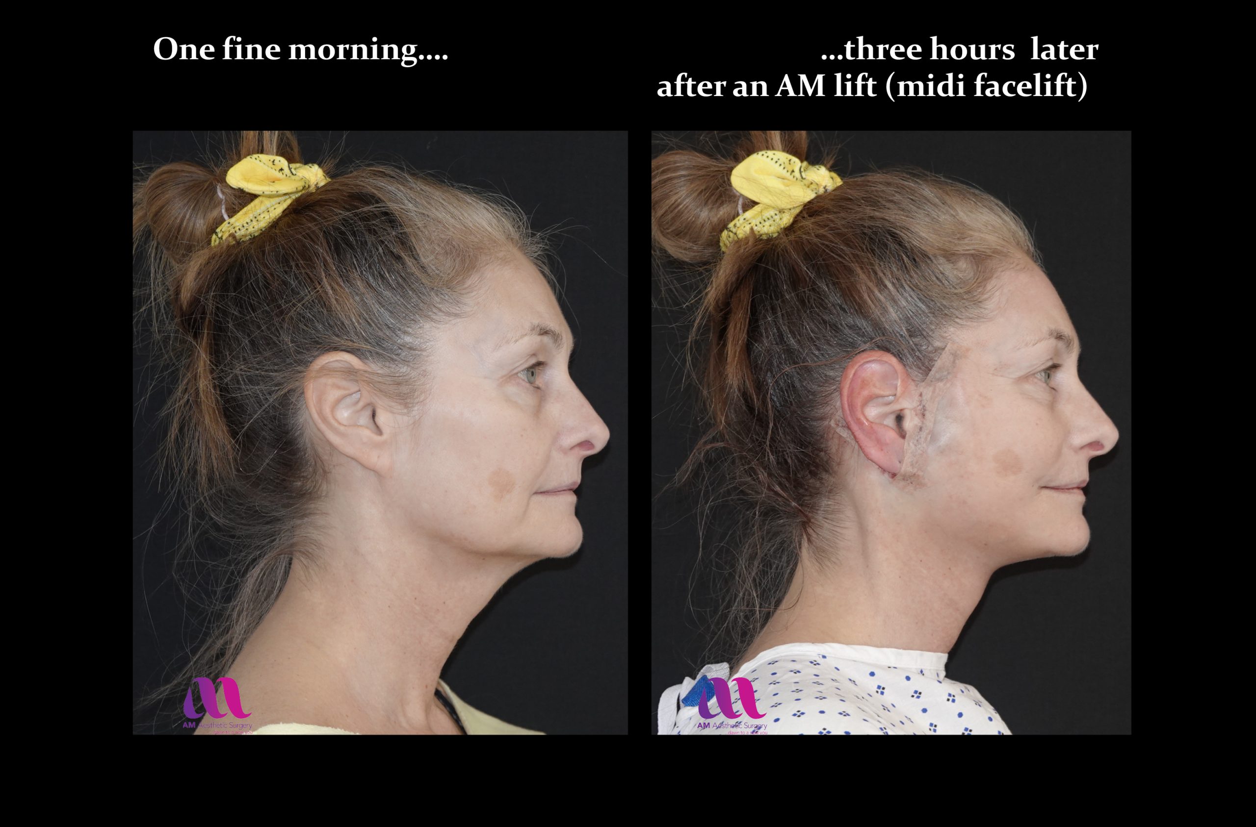 Mini or Midi Face Lift – The AM Lift – A M Aesthetic Surgery